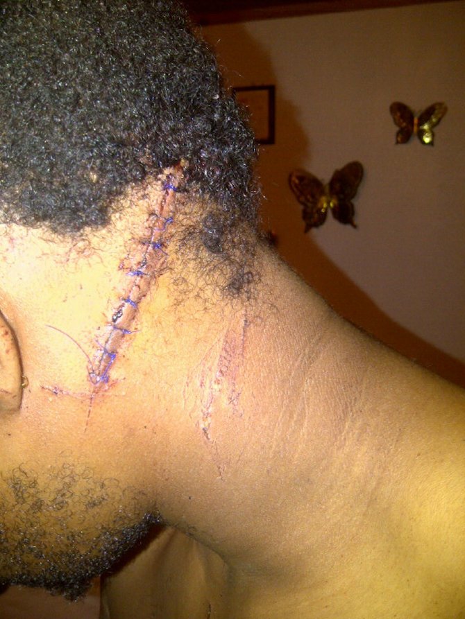 THE VICTIM shows some of the injuries he sustained when stabbed by a man with 'a small sword'