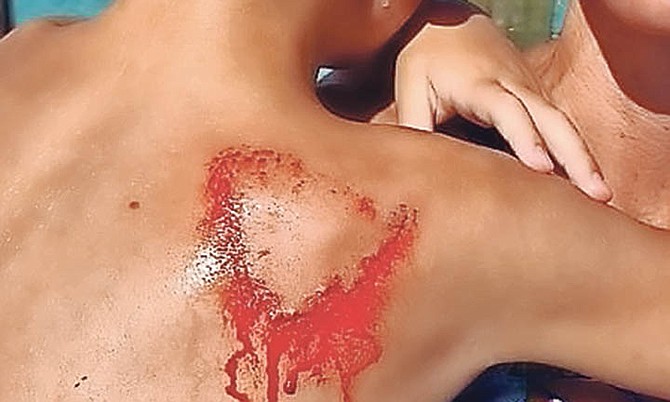 Asher Jones was bitten by a nurse shark off the Exuma Cays.