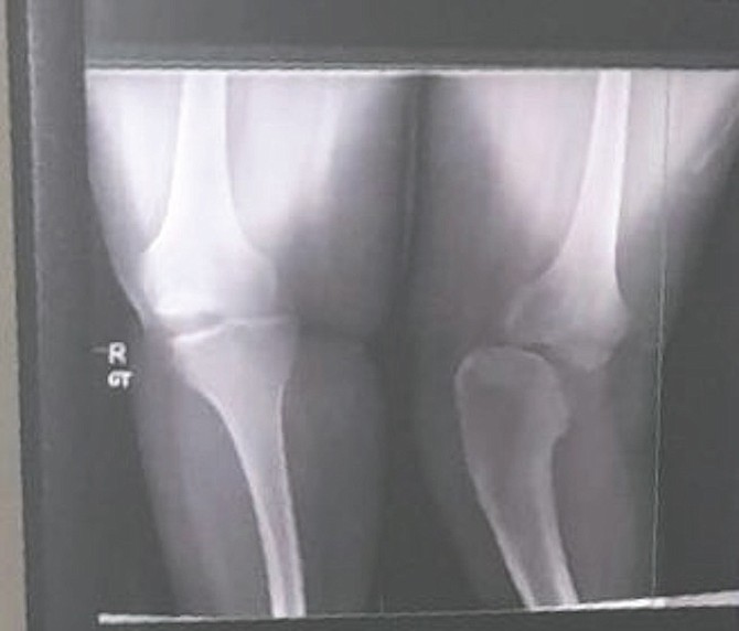 KEIRANIQUE Dorsett was born without fibular bones (as seen in the x-ray above) and other conditions that have severely impacted her life. She is hoping to raise enough funds through a GoFundMe to have surgery that would help her live a more normal life.