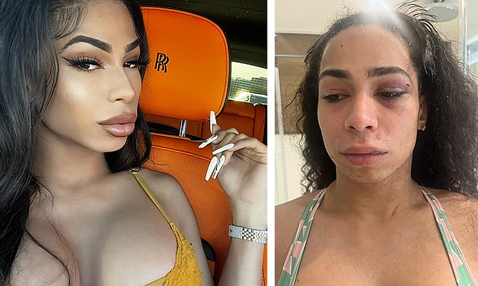 TRANSGENDER woman China Diamond was allegedly assaulted at a club on West Bay Street in what
is being called a hate crime. The picture on the right shows her with a black eye.