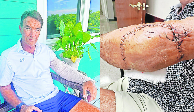 Shark attack victim Mike Raich and the injury he suffered.