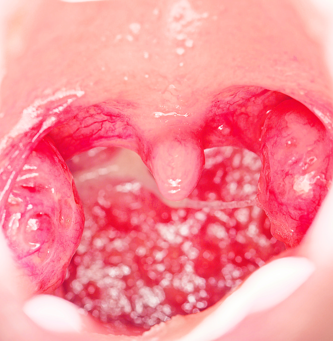 ‘Swallowing was the worst part, eliciting pain that I dared not express. Every gulp felt like hot lava cutting its way through my neck.’